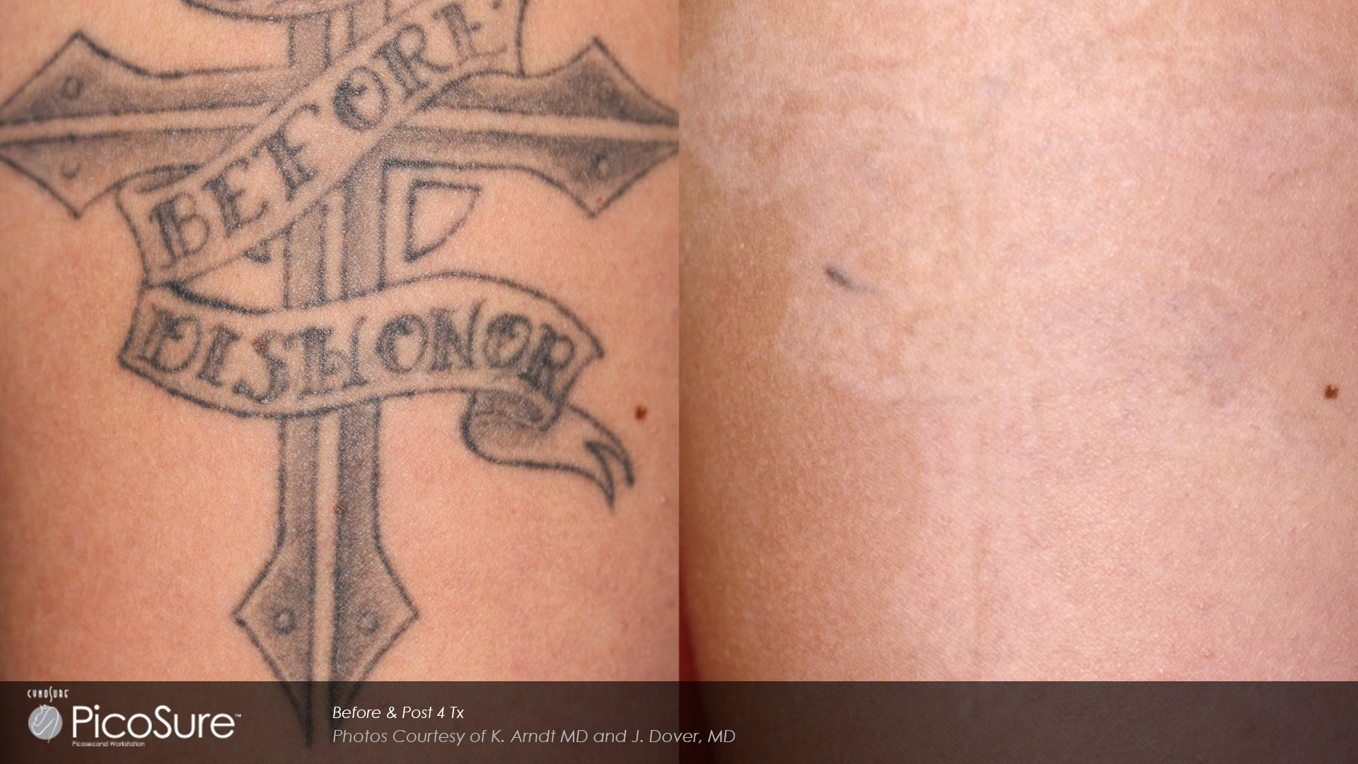 Before and After of laser tattoo removal Picosure. Location: Raleigh ...